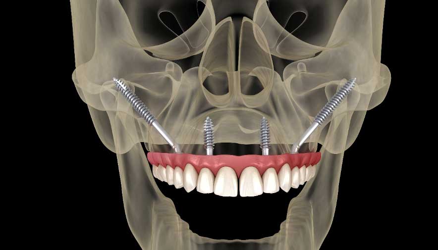 implantes cigomaticos