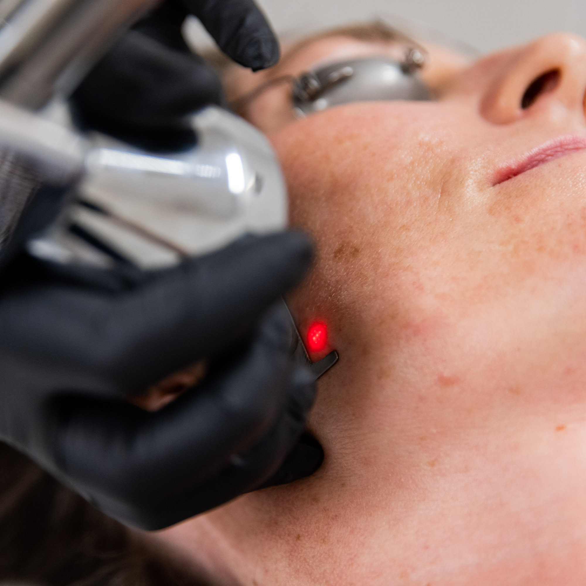 Skin Rejuvenation | MicroLaser Peel & Pro Fractional - PURE Medical Spa