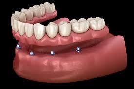 Dental Implants vs Snap-on Dentures: Which Option is Right for You?...