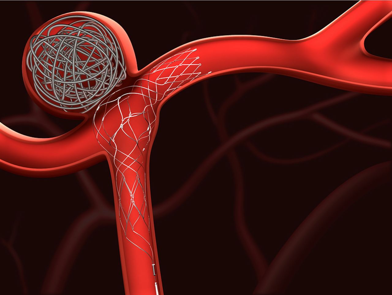 Understanding Coiling Brain Aneurysm Treatment: Your Comprehensive Guide