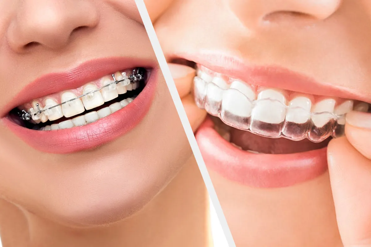Invisalign in RR Nagar at the Leading Dental Clinic – Site Title