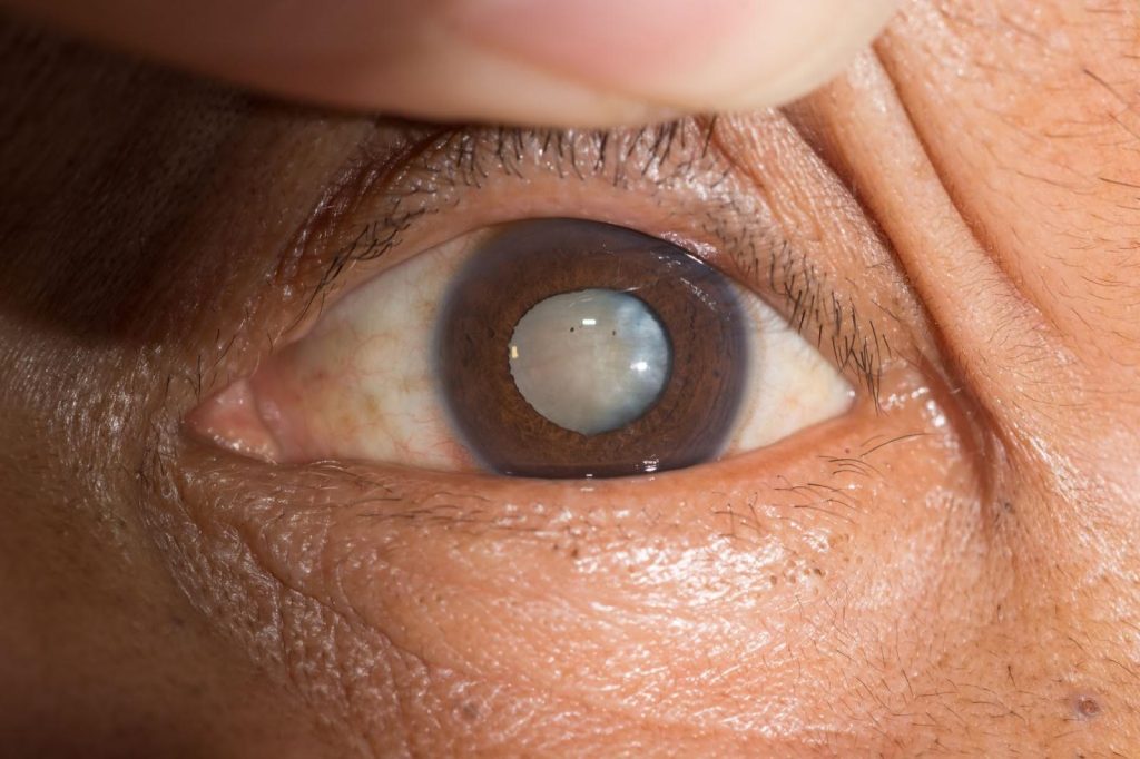Cataract Removal Treatment | Eye Co Ophthalmic Surgeons