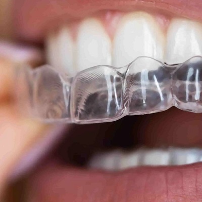 Teeth Aligners Price in Pakistan