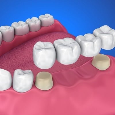 Dental Crowns in Islamabad Pakistan | Dental Caps