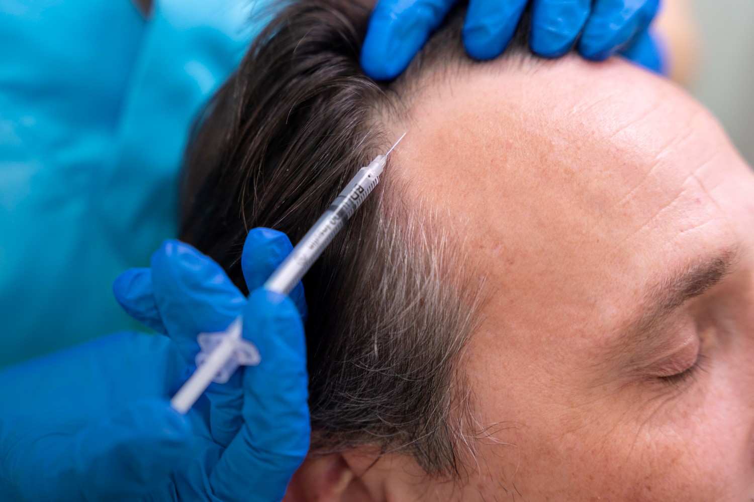 How PRP Treatment in Bangalore Helps Restore Confidence Naturally