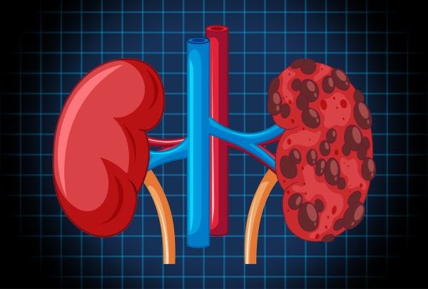 Stages of Kidney Cancers: What Patients Need to Know
