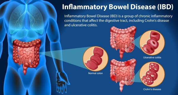 Types of Inflammatory Bowel Disease: Crohn’s Disease vs Ulcerative Colitis