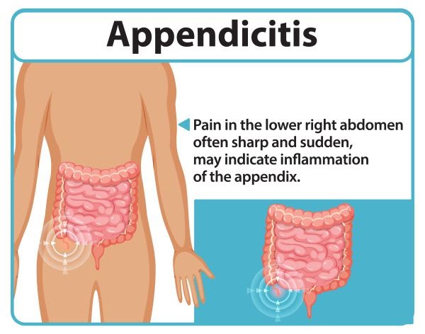 Common Myths and Facts About Appendicitis