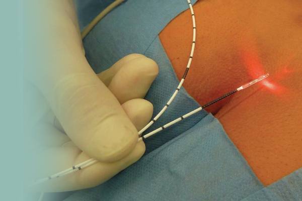 Laser Pilonidal Sinus Treatment in PCMC, Pune | Apex Multispeciality Hospital