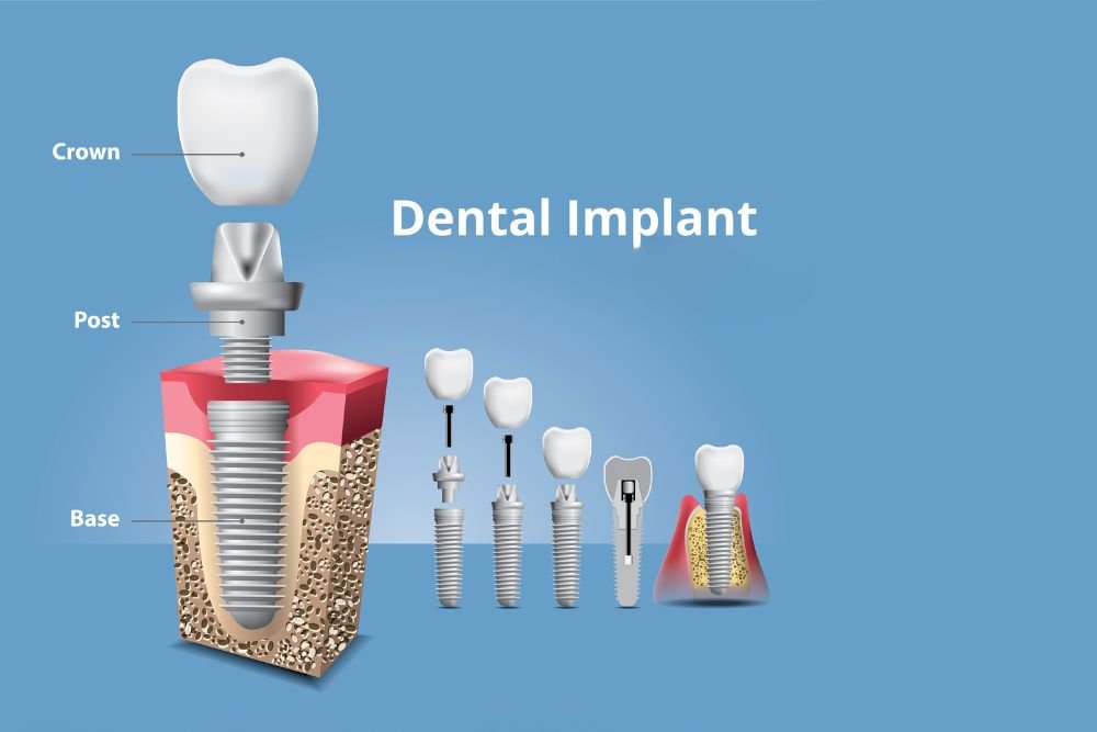 Dental Implants in Carlisle, Implant Dentist & Clinic | Carlisle Dental Care