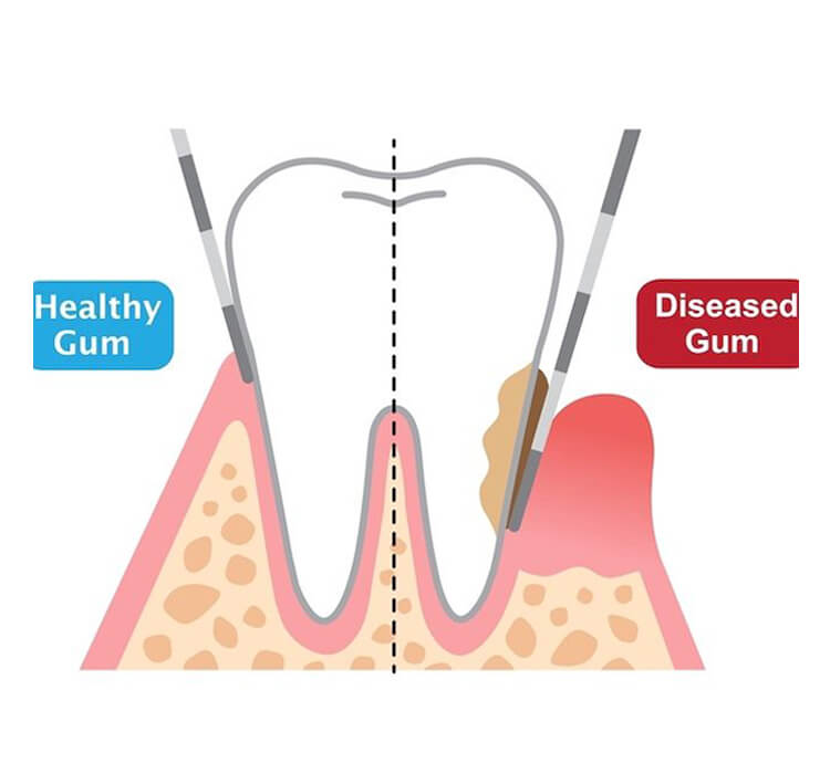 Chronic Gum Disease Treatment Melbourne | Holistic Dental Donvale