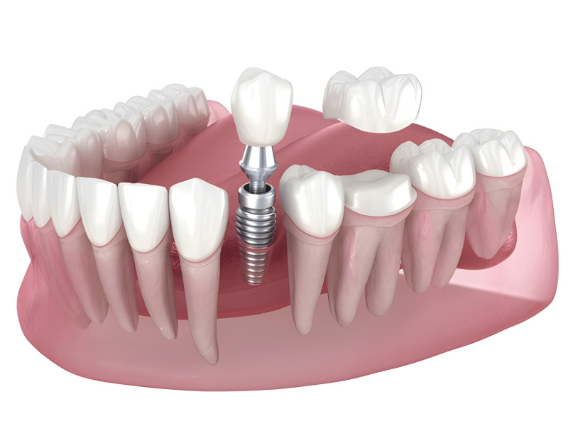 Dental Implants Explained: The Permanent Solution for Missing Teeth : ext_6847076 — LiveJournal