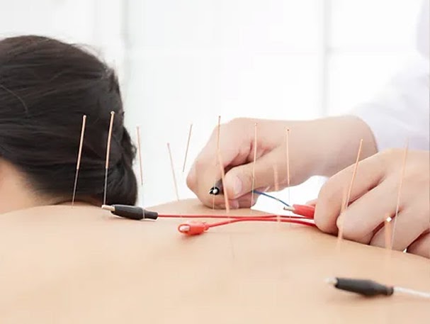 The Power of Acupuncture and Cupping Therapy in RR Nagar