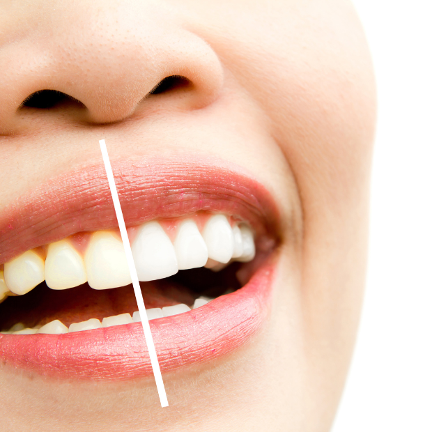 Teeth Whitening in Norristown, Teeth Whitening Treatments | Amor Dental Arts