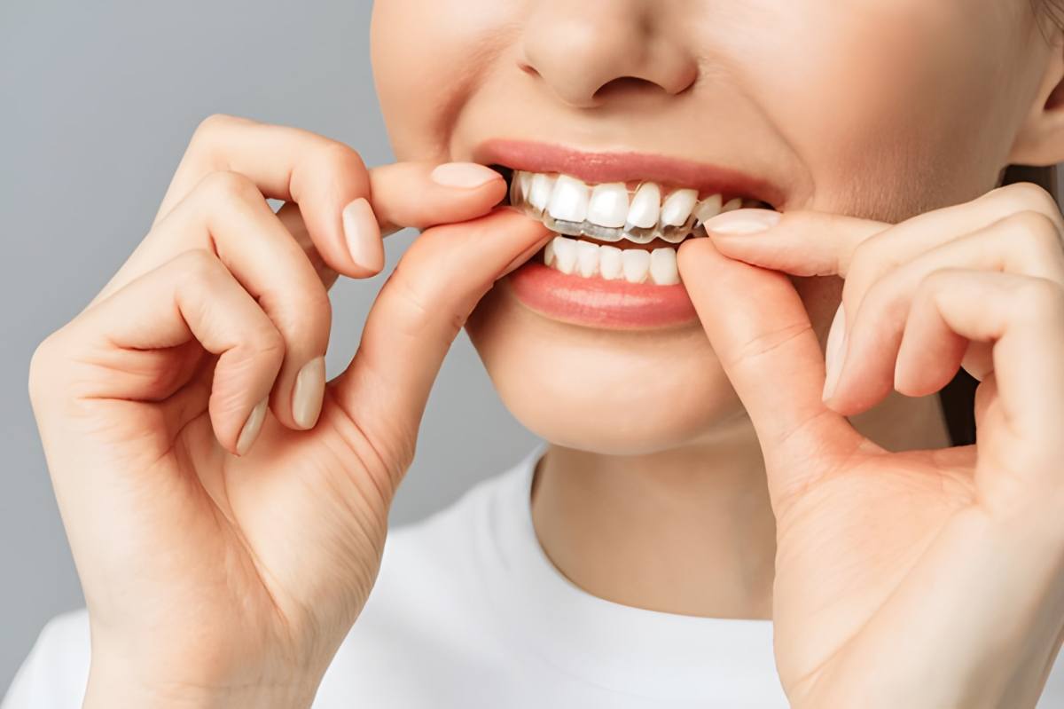 Invisalign Explained: How Clear Aligners Straighten Your Teeth Without Braces – Carlisle Dental Care