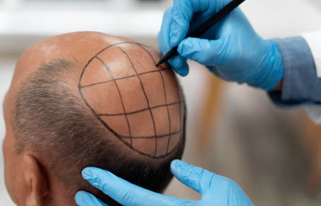 Hair Tattoo SMP versus Hair Transplant Which Works Better