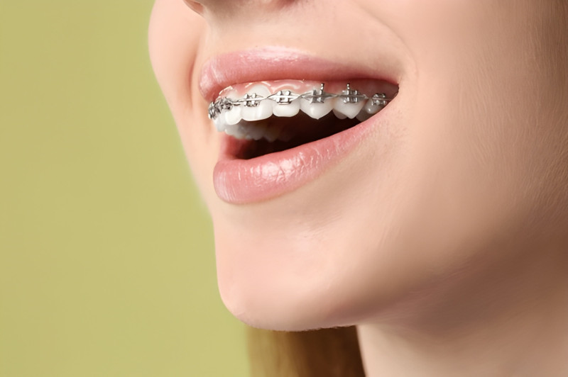 Braces vs. Aligners: Which Smile Solution Fits You Best?: ext_6847076 — LiveJournal