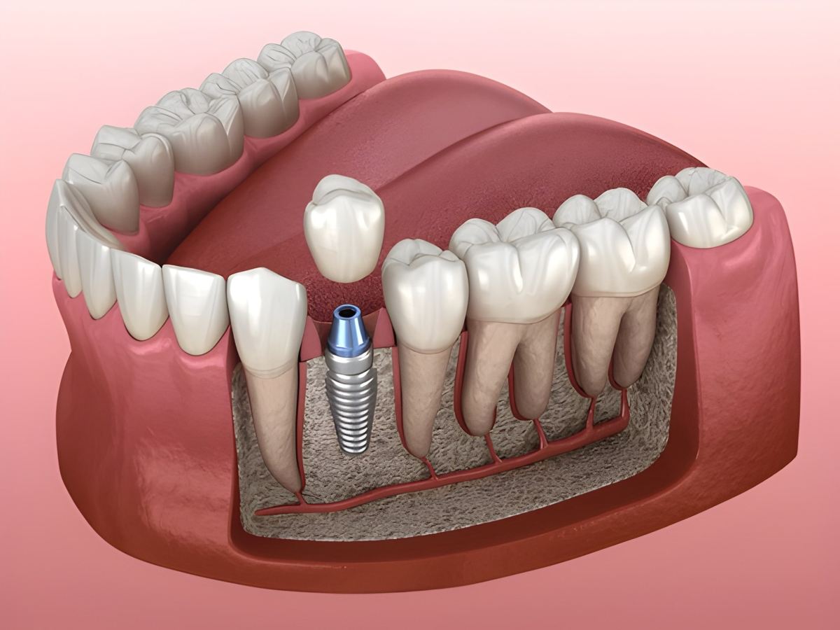Top 10 Reasons Why Dental Implants Are the Best Tooth Replacement Option – Carlisle Dental Care