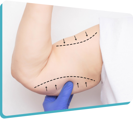 عملية شد الذراعين في الرياض والسعودية