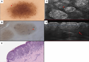 New Insights from High Magnification Dermoscopy, Confocal Microscopy and Line-field Confocal Optical Coherence Tomography (LC-OCT) on Peripheral Globular Melanocytic Nevi - Athenaeum Scientific Publishers