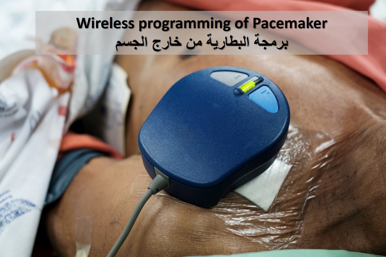 Pacemaker Surgery in Dubai | Expert Cardiac Care