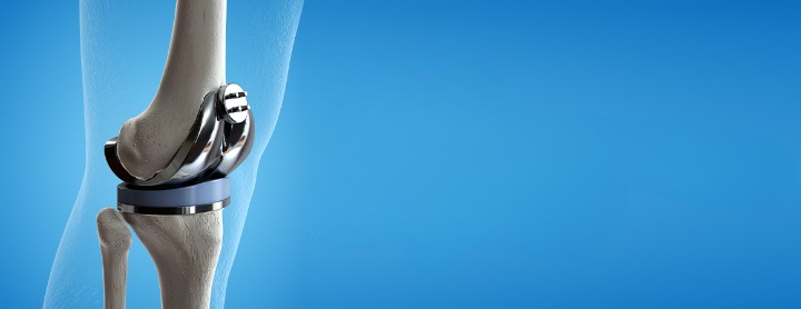 Knee Replacement Packages Abroad | Affordable Surgery UK