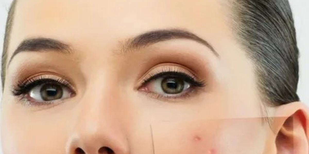Proven Pimples Treatment in Dubai for Smooth Texture