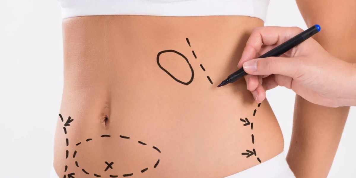Liposuction in Islamabad and Best Areas for Fat Removal