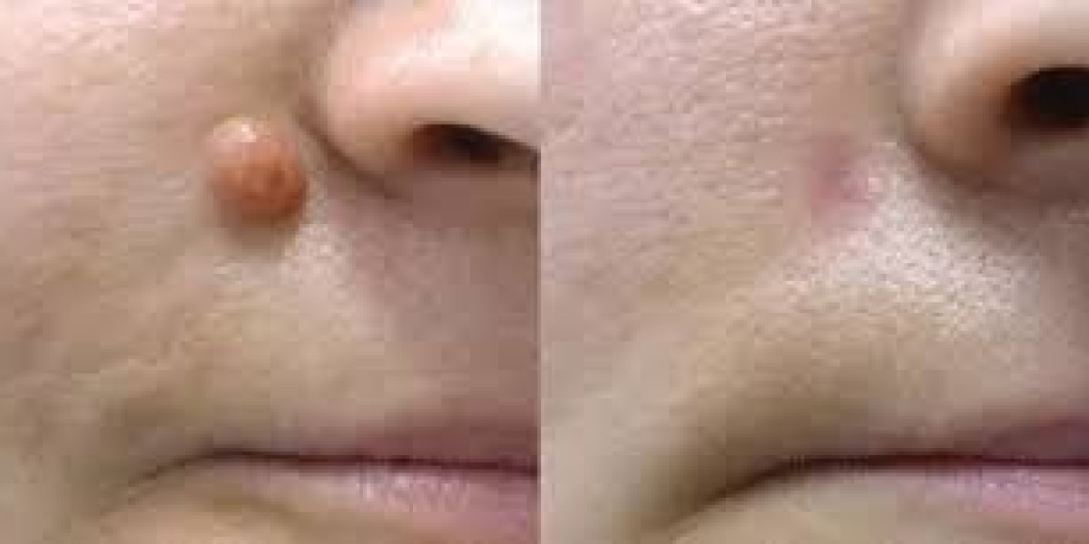 Common Reasons People Seek Mole Removal in Dubai