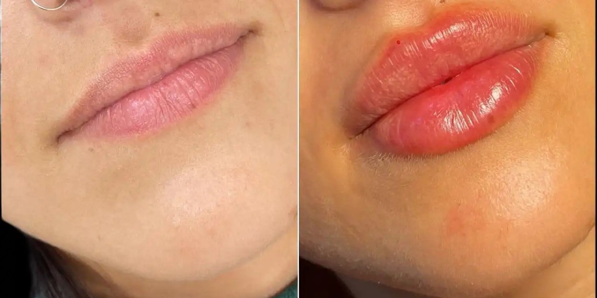 Confidence Boost with Fillers for Best Doctors in Dubai