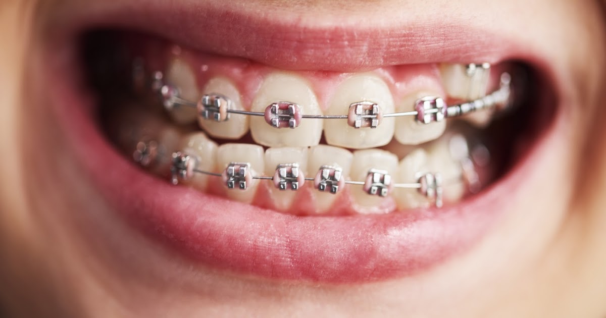 Who Offers Invisible Braces in Seattle?