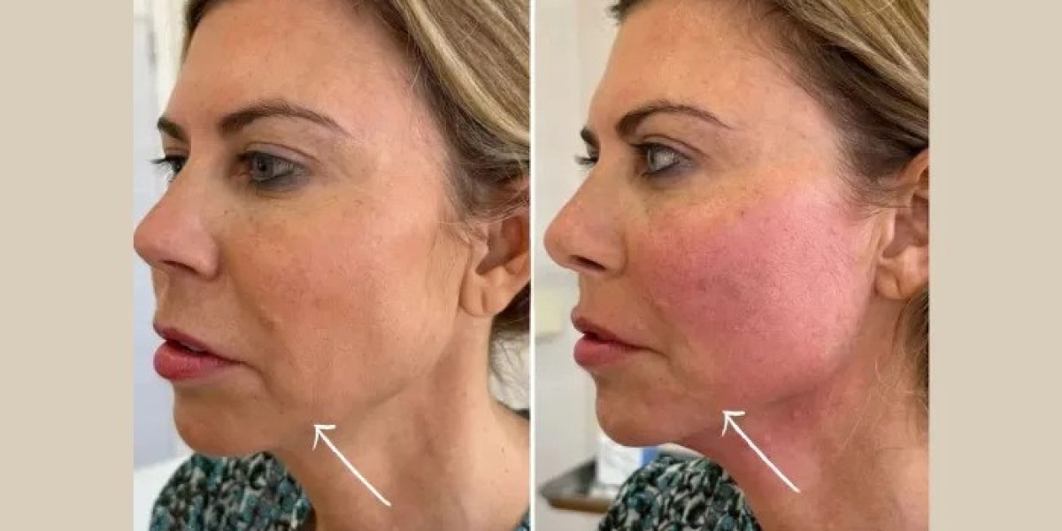 Best Aesthetic Clinics in dubai Providing Long Lasting Endolift Benefits