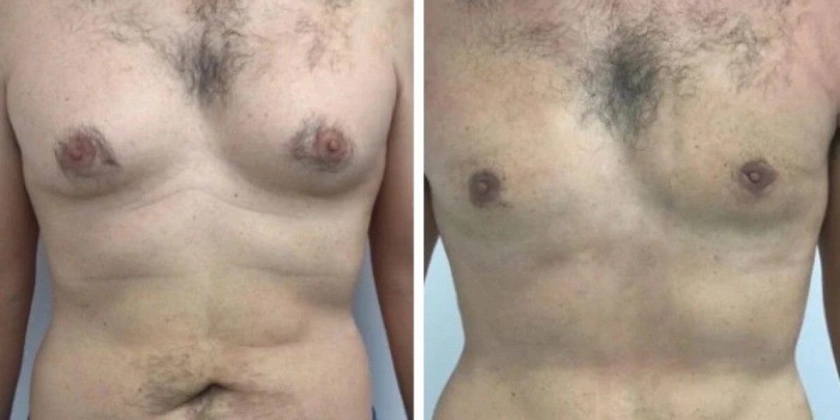 Understanding Recovery Timeline After Gynecomastia in Dubai Surgery