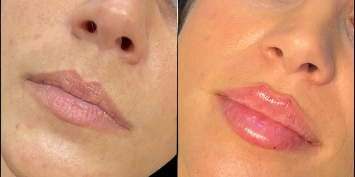 Best Doctors in Dubai for Safe Cosmetic Dermal Fillers Injections