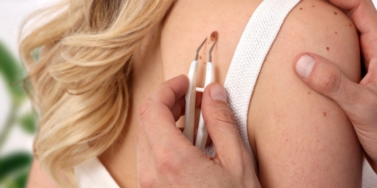 The Influence of Modern Beauty Culture on Mole Removal in Islamabad