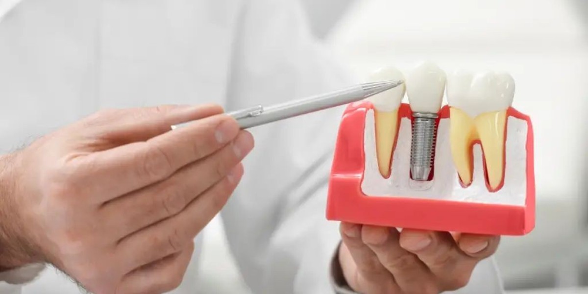 Dental Implants in Dubai: Everything You Need to Know About Restoring Missing Teeth