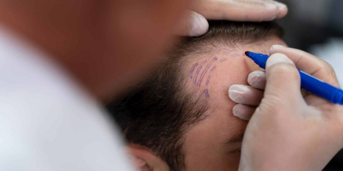 Cost Factors You Should Know About Hair Transplant in Islamabad