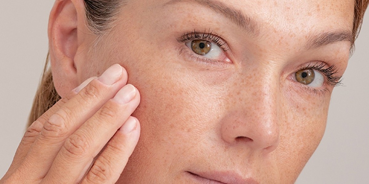 Why More People Are Choosing Melasma Treatment in Islamabad for Clearer Skin