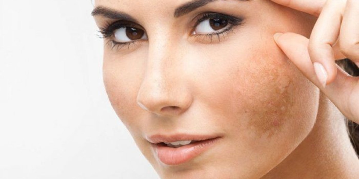 What Causes Skin Pigmentation and How Can It Be Treated?