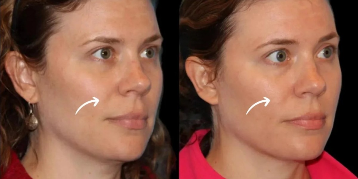 Sculptra Fillers Treatment in Dubai for Buttock Projection