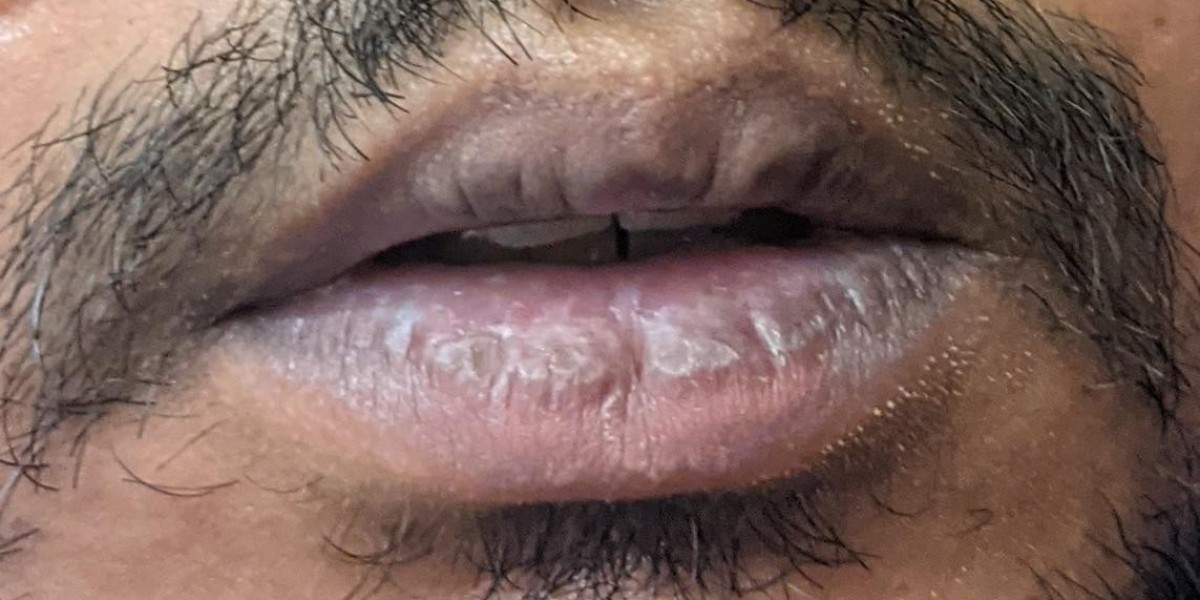 Smoker Lips Treatment in Islamabad: A Complete Beginner’s Guide