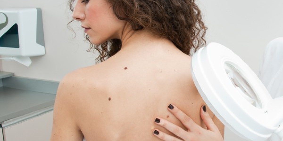 Why People Prefer Professional Mole Removal in Islamabad