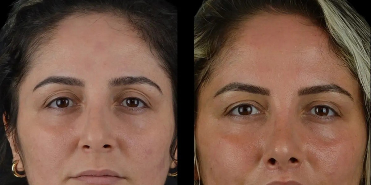 How the Best Doctors in Dubai Use Cheek Fillers to Sculpt the Perfect Face