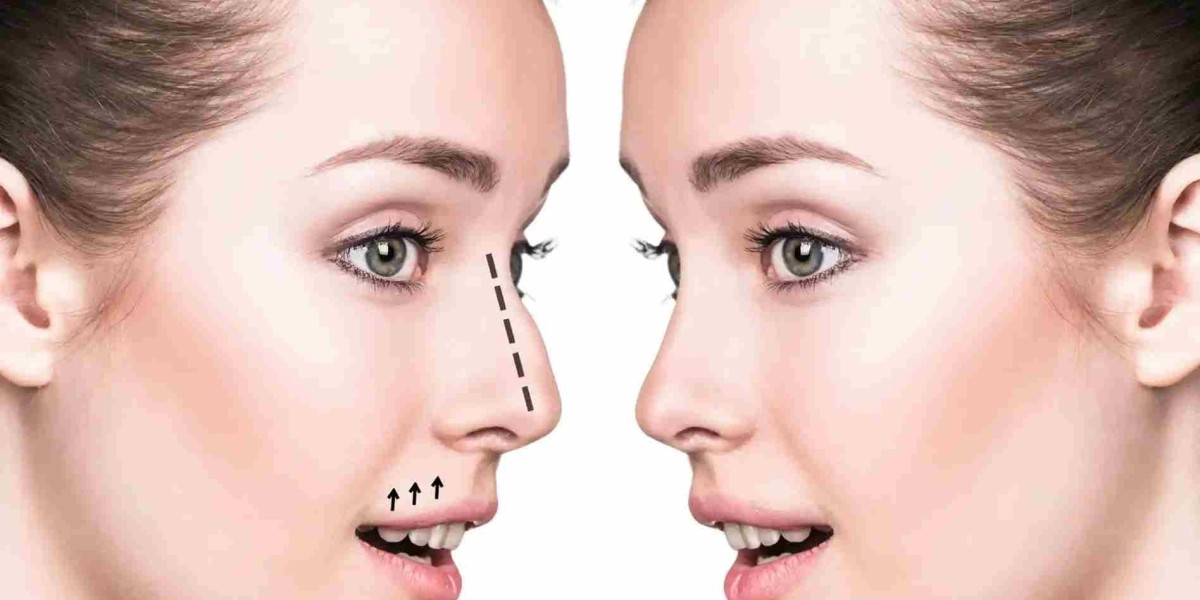 How Best Doctors in Dubai Tailor Every Rhinoplasty Procedure