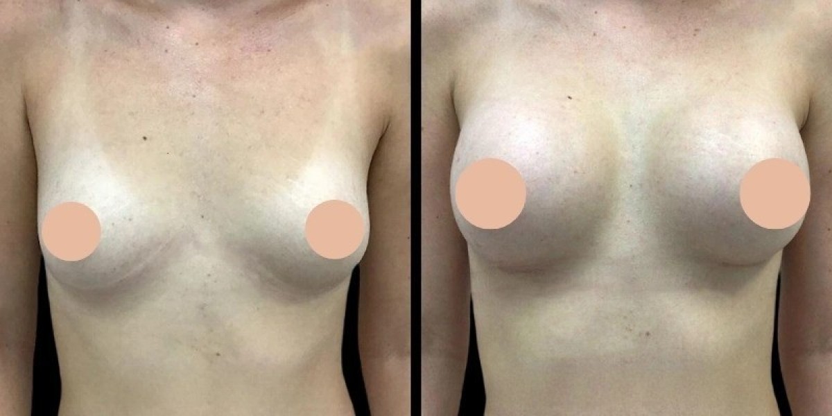 Breast Augmentation in Dubai: How Age Can Influence Your Results