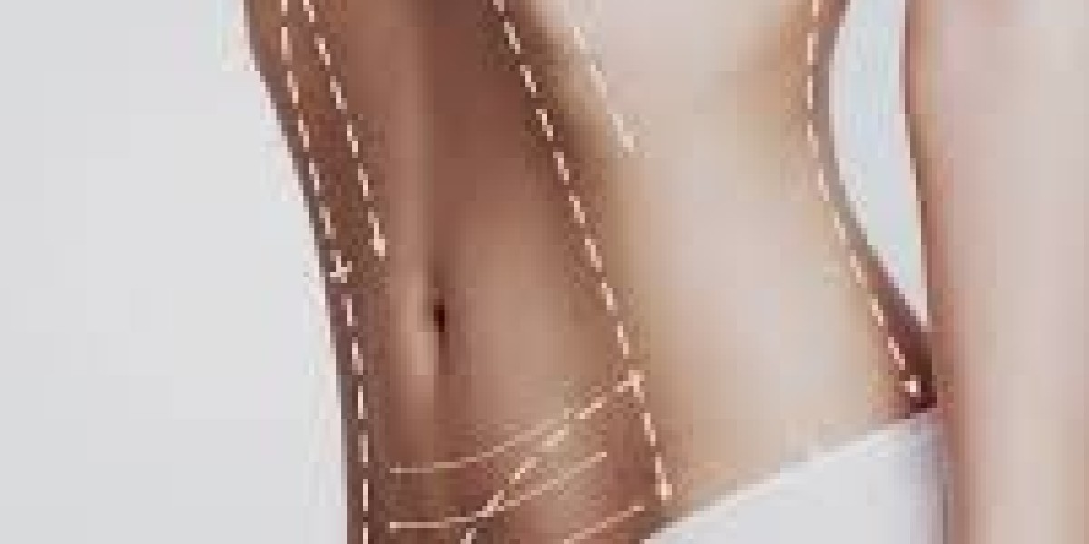 Liposuction Surgery in Islamabad: Is It the Right Solution for You?