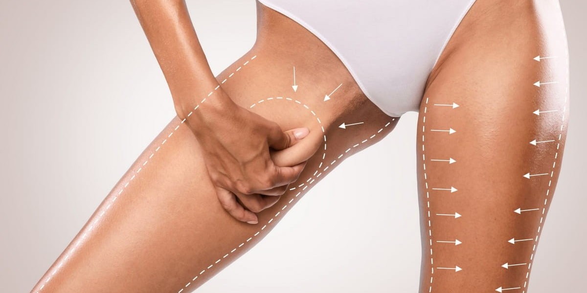 Complete Guide to Thigh Liposuction in Islamabad for Beginners