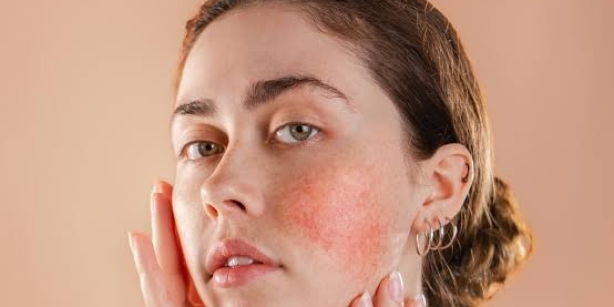 Achieving Flawless Skin with Rosacea Treatment In Islamabad