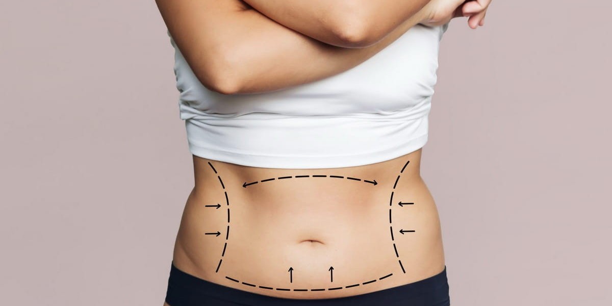 Liposuction in Islamabad: What to Expect During Your Transformation Journey