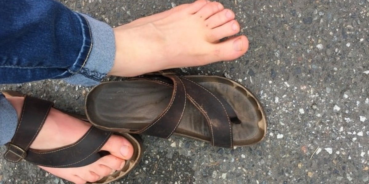 Tips for Managing Sweaty Feet and Hyperhidrosis Edinburgh